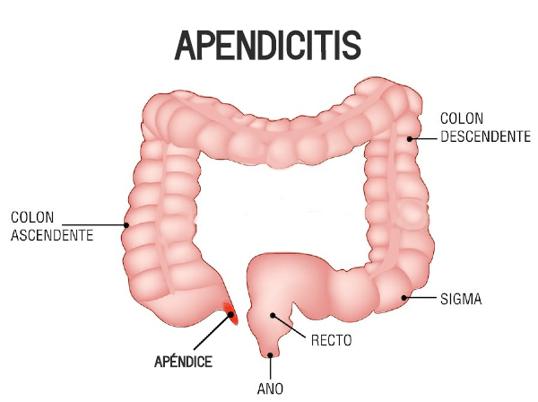 Apendicitis