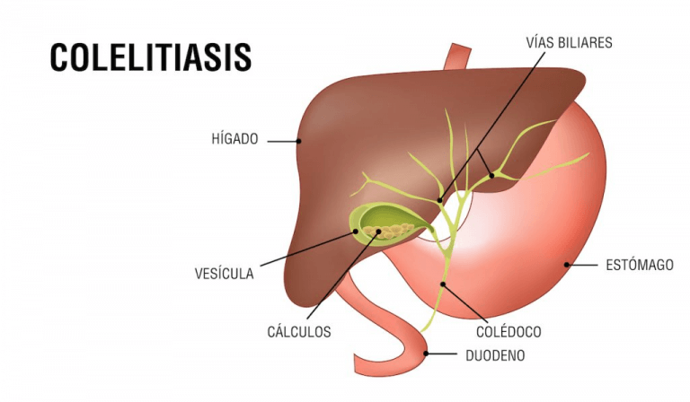 Colelitiasis (Cálculos en la vesícula) - Barialap