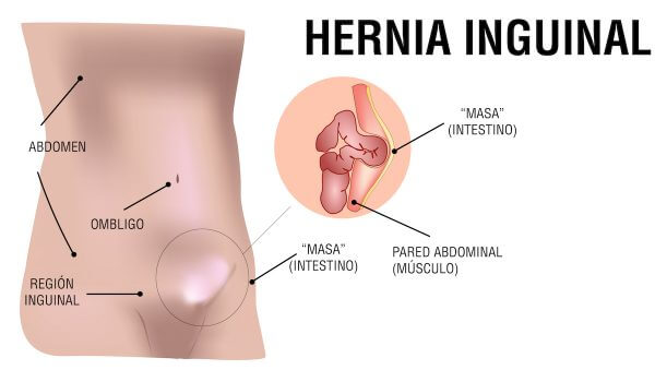 Hernia Inguinal - Barialap