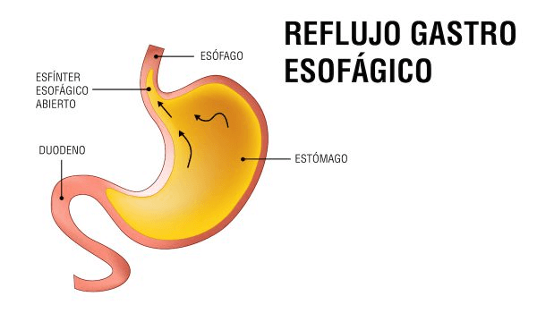 ERGE-Barialap